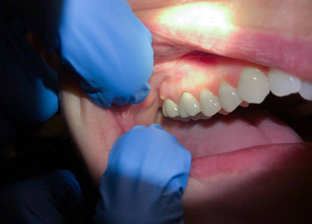 Best Urgent Tooth Repair  in Glenshaw, PA