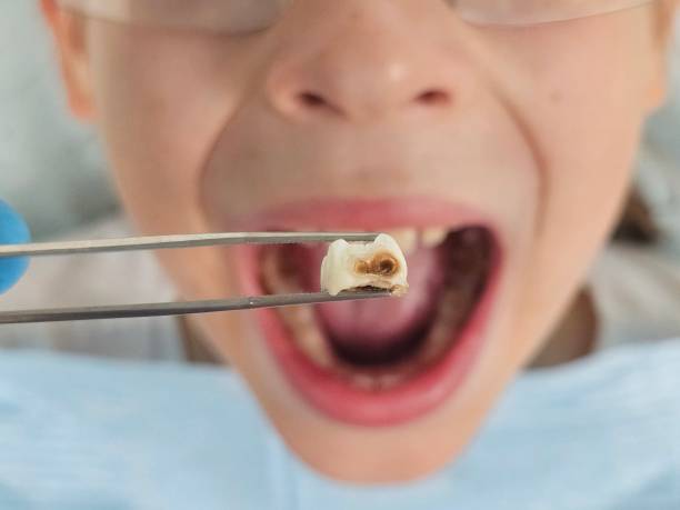 Best Chipped Tooth Repair Near Me  in Glenshaw, PA